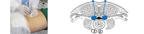 Etapas de la Hernia de Disco