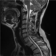 Canal Estrecho Cervical