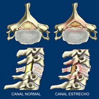 Canal Estrecho Cervical