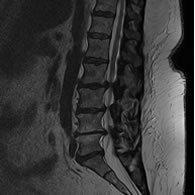 Canal Estrecho Lumbar