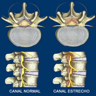 Canal Estrecho Lumbar