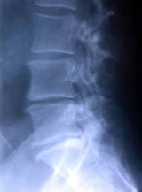 Hernia de Disco Cervical